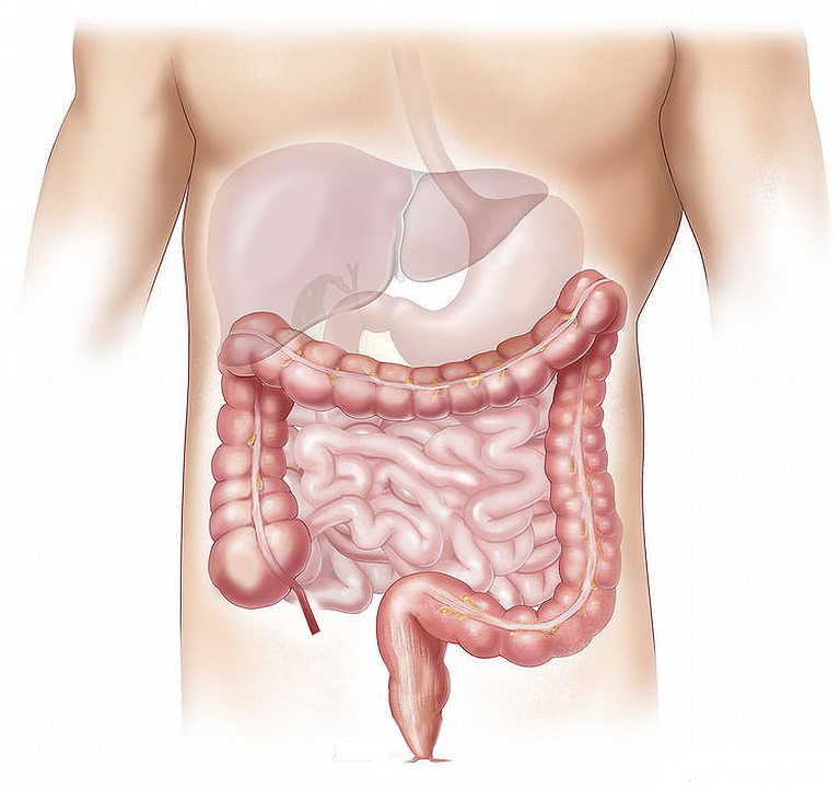 Você sabe o que é doença diverticular? 