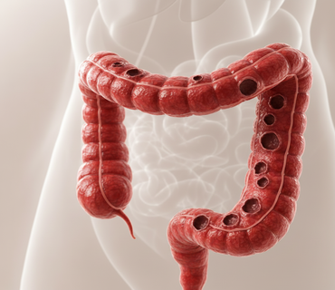 Inflamatórias Intestinais 